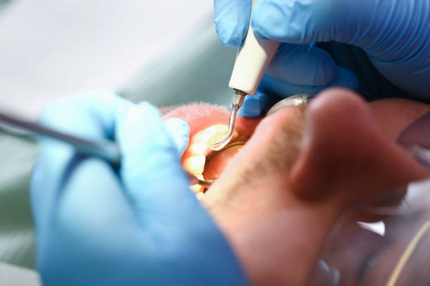 Best Dentist for Tooth Abscess  in Cibecue, AZ